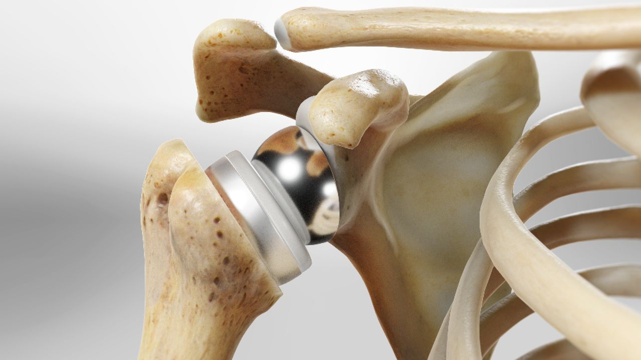 Total Shoulder Arthroplasty MultiCenter Registry Andrews Research & Education Foundation
