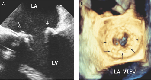 Infective Endocarditis Anesthesia Key