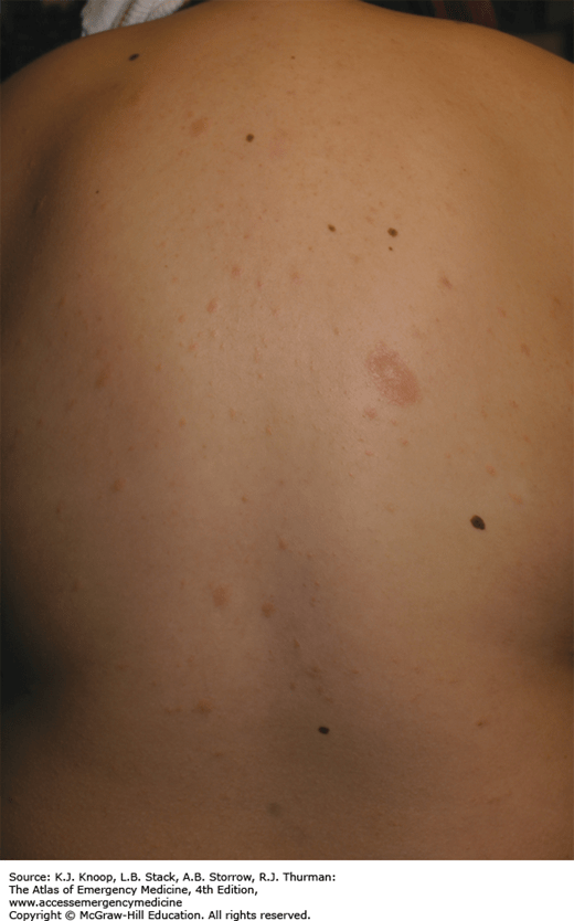 CUTANEOUS CONDITIONS Anesthesia Key