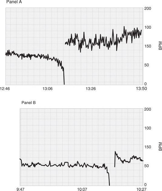 Hemodynamic Complications Anesthesia Key