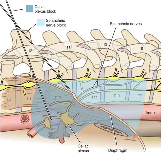 Complications Associated with Neurolytic Celiac Plexus Block