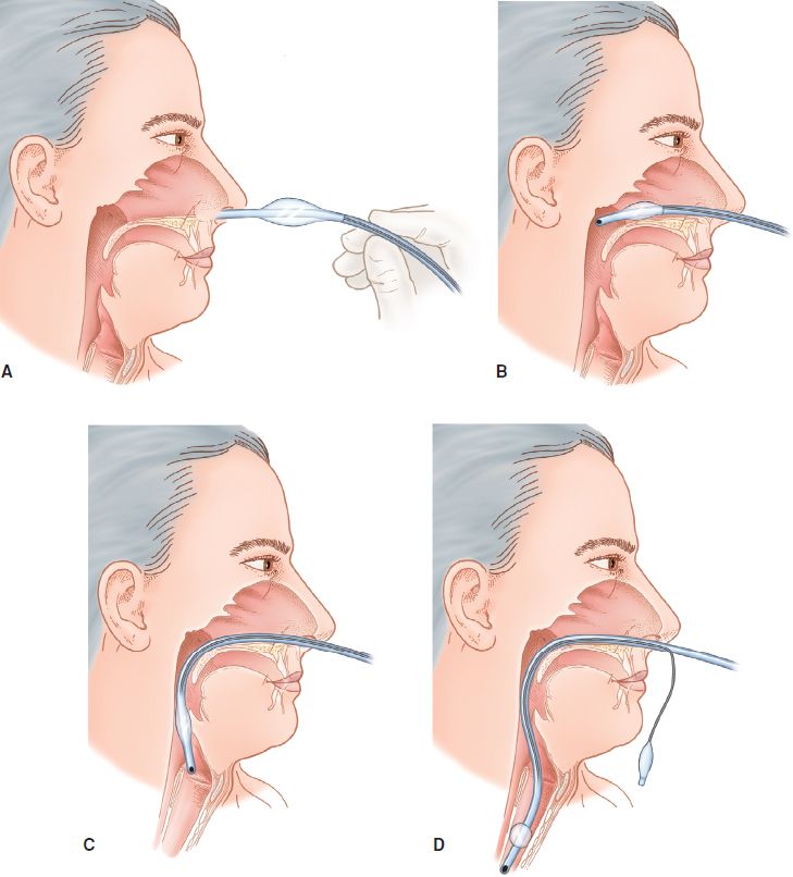 Airway Procedures Anesthesia Key