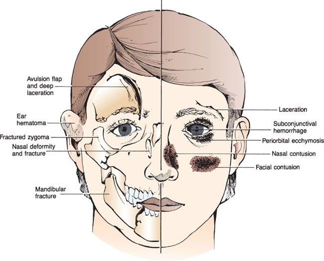 Maxillofacial Injuries Anesthesia Key