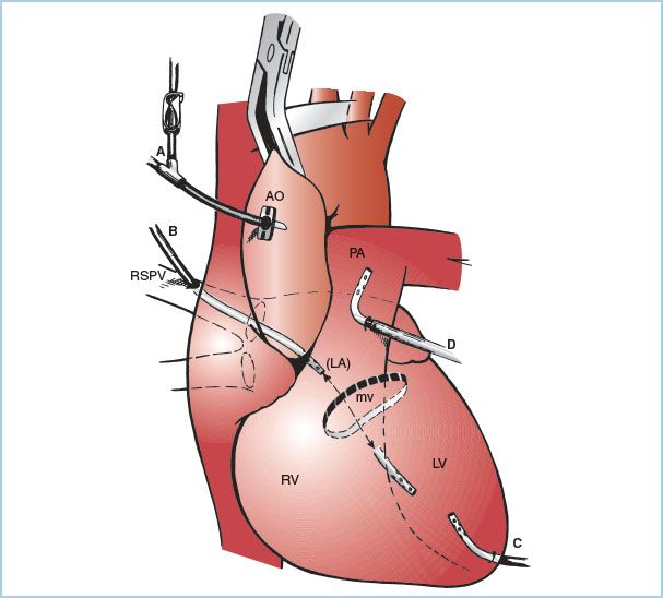 Cardiopulmonary Bypass: Equipment, Circuits, and Pathophysiology