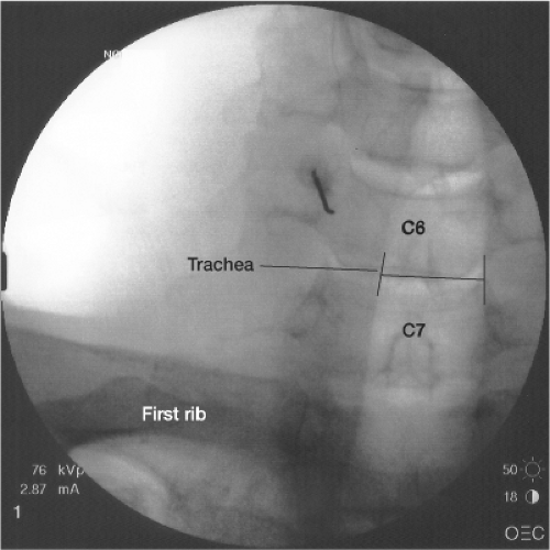Sympathetic Blocks Stellate, Celiac, Lumbar, Superior Hypogastric, and