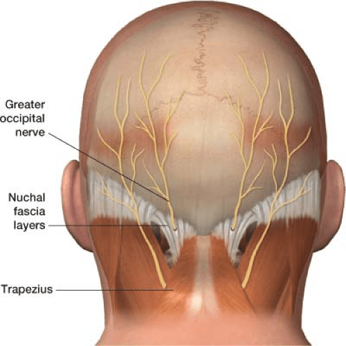 Injections for Headache (Occipital Nerve Blocks and Botulinum Toxin Injections) Anesthesia Key