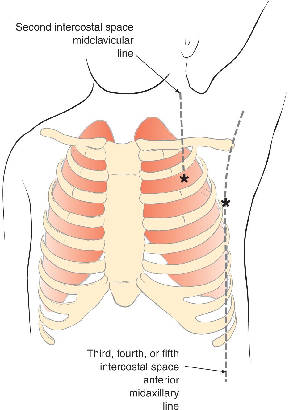 How To Do Chest Tube Thoracostomy at Gwen Frizzell blog