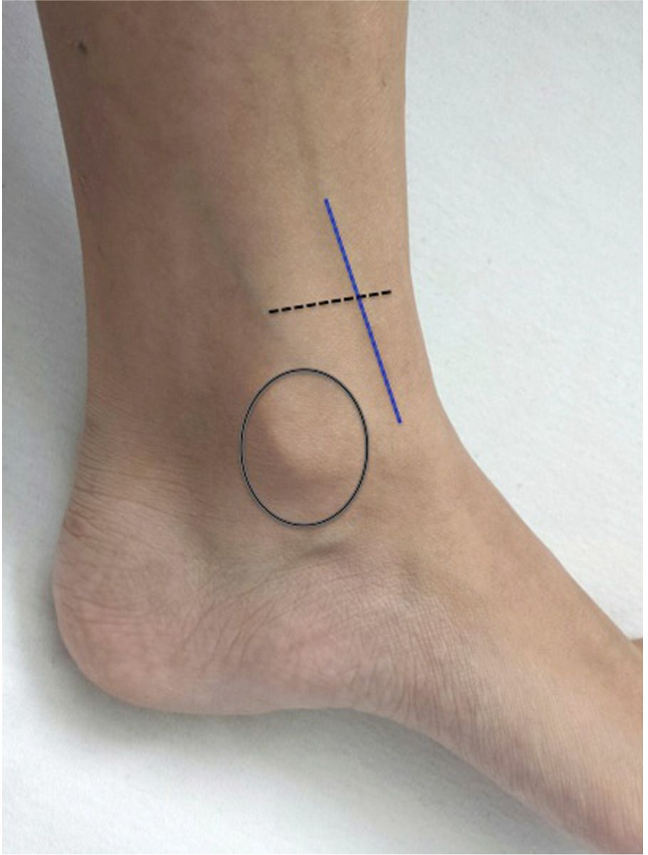 Peripheral Venous Cutdown—Saphenous Vein at Ankle Anesthesia Key