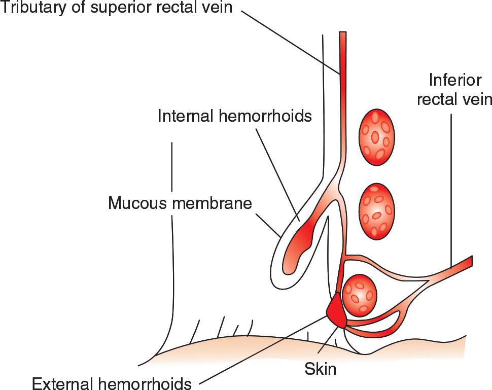 Excision of Acutely Thrombosed External Hemorrhoids Anesthesia Key