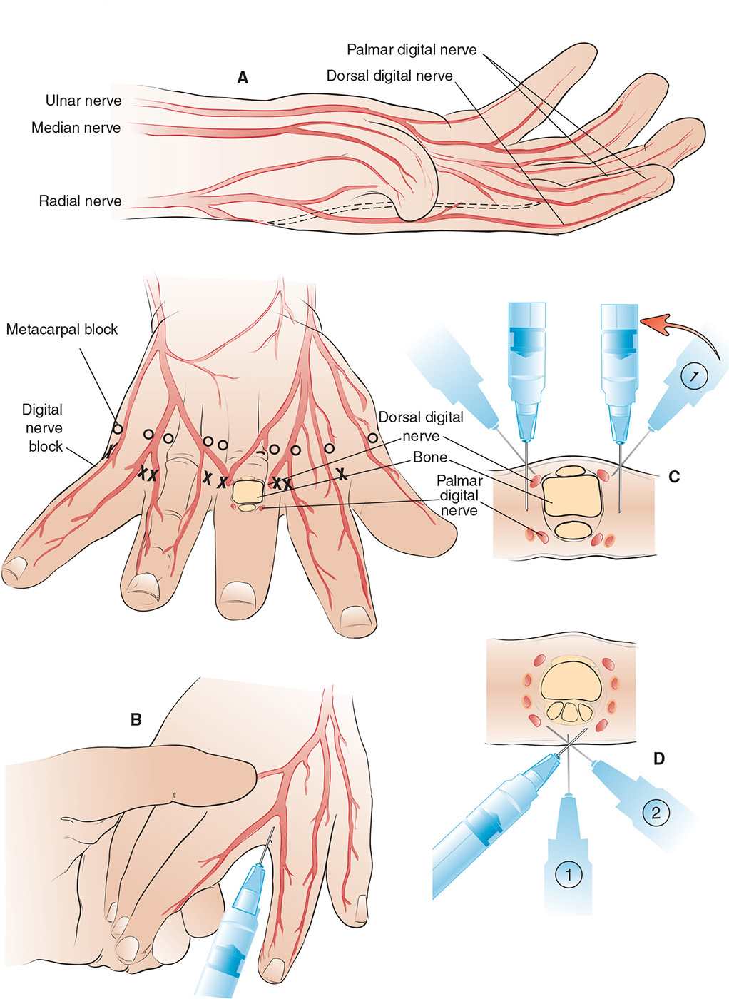 Digital Nerve Block Anesthesia Key