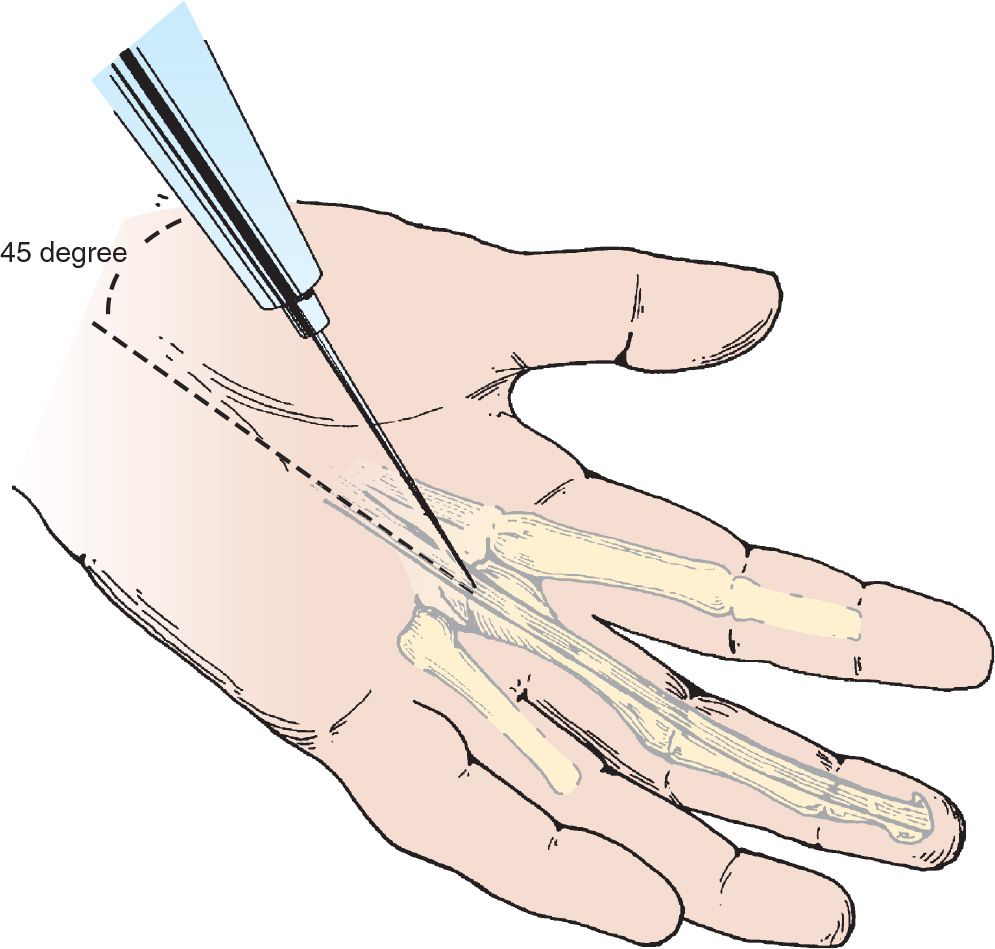 Digital Nerve Block Anesthesia Key