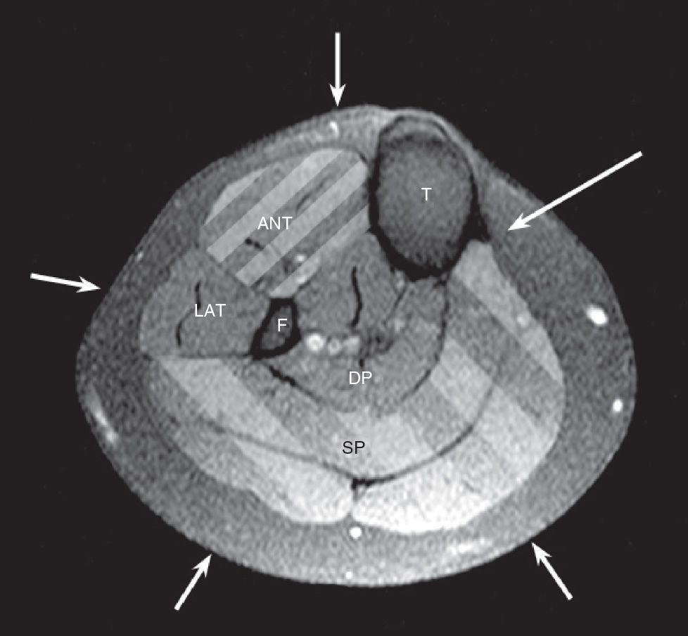Measurement of Compartment Pressures Anesthesia Key
