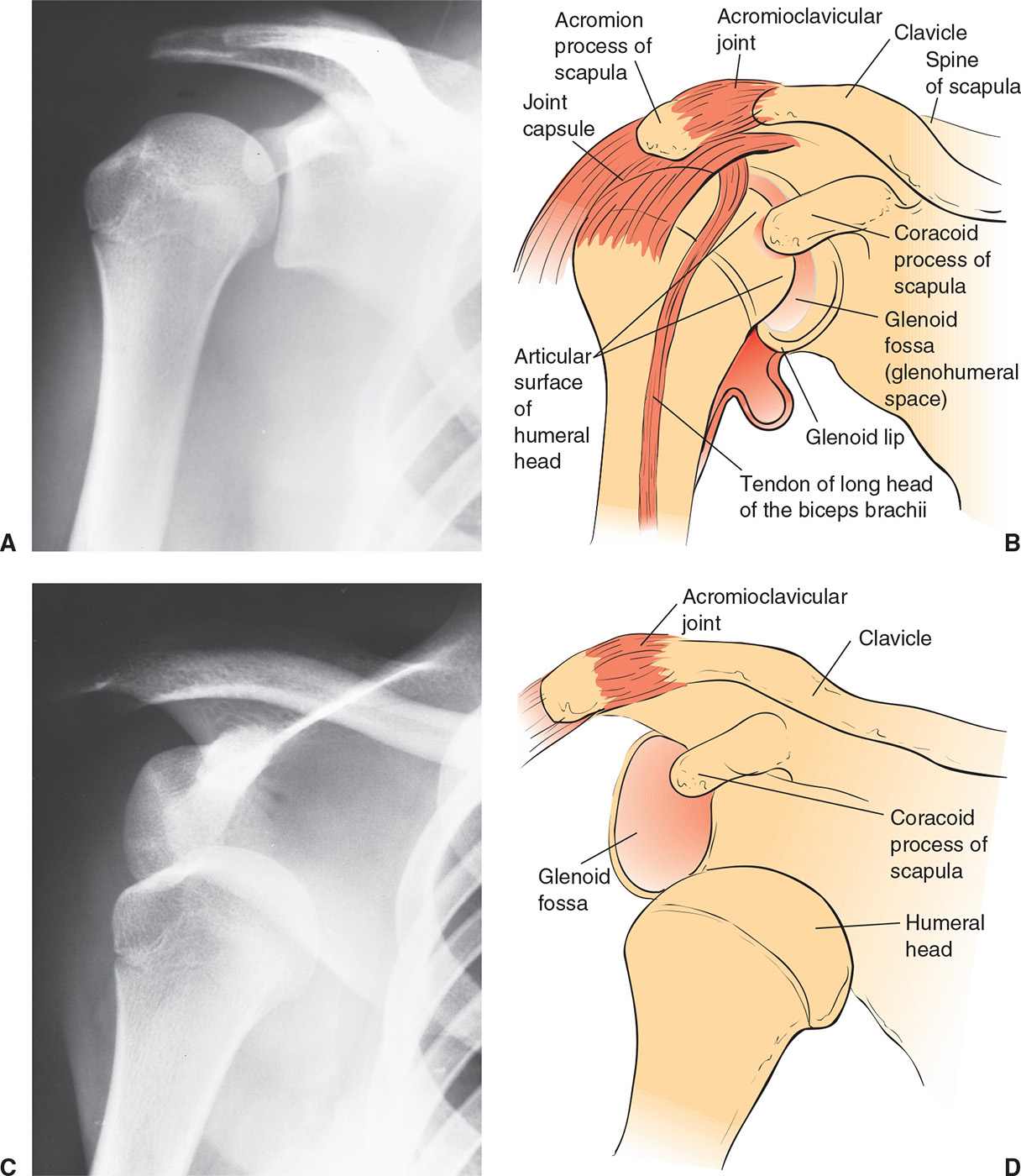 Shoulder Dislocation and Reduction Anesthesia Key