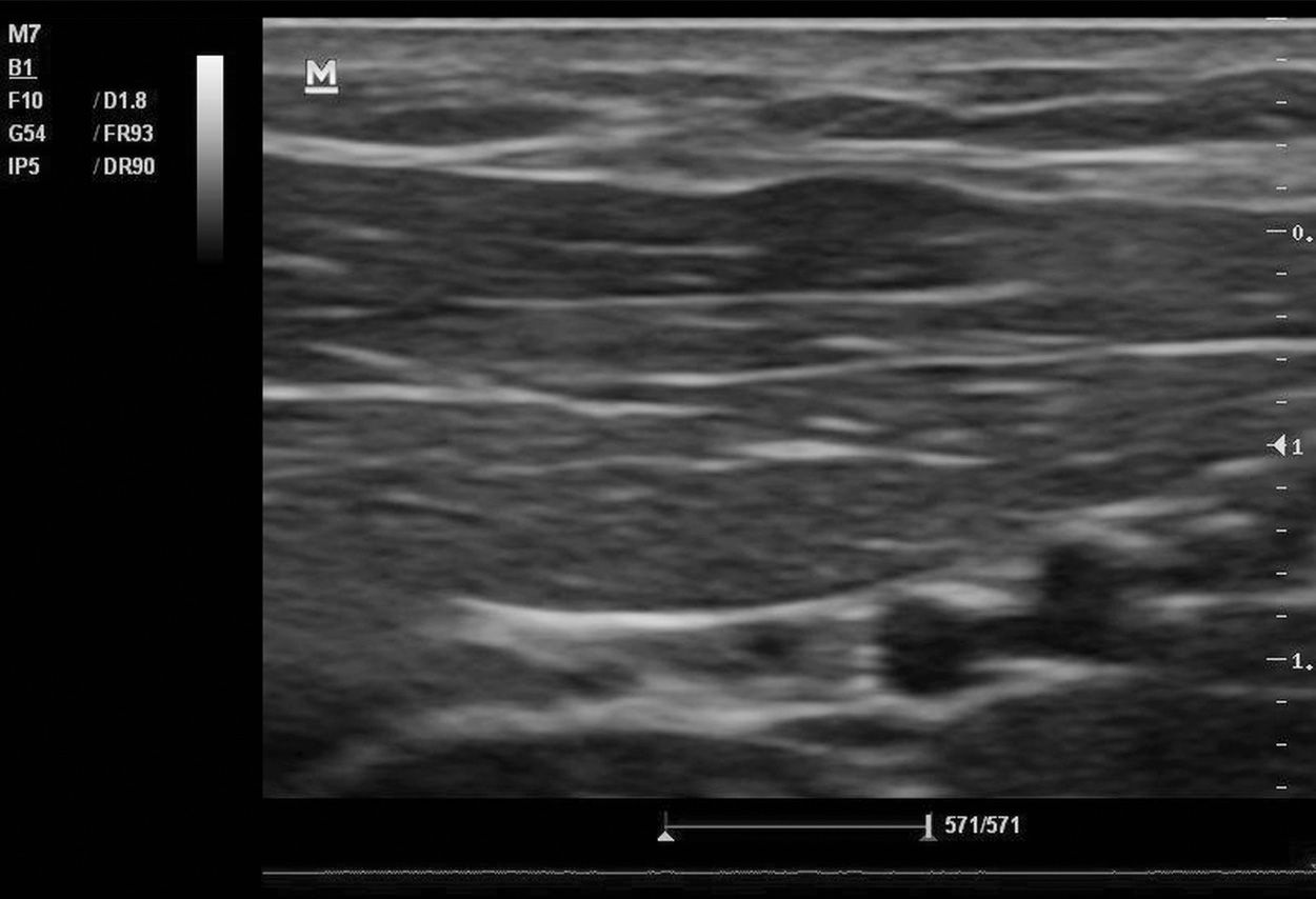 Skin and SoftTissue Ultrasound Anesthesia Key