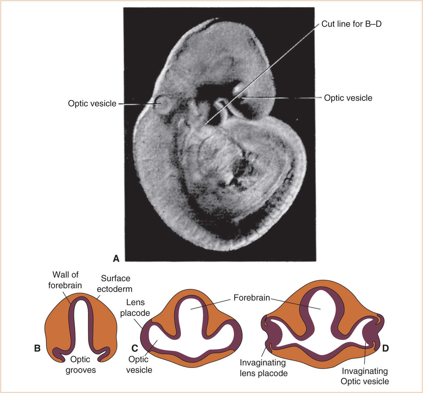 The Eye Pediatric Ophthalmological Surgery Anesthesia Key