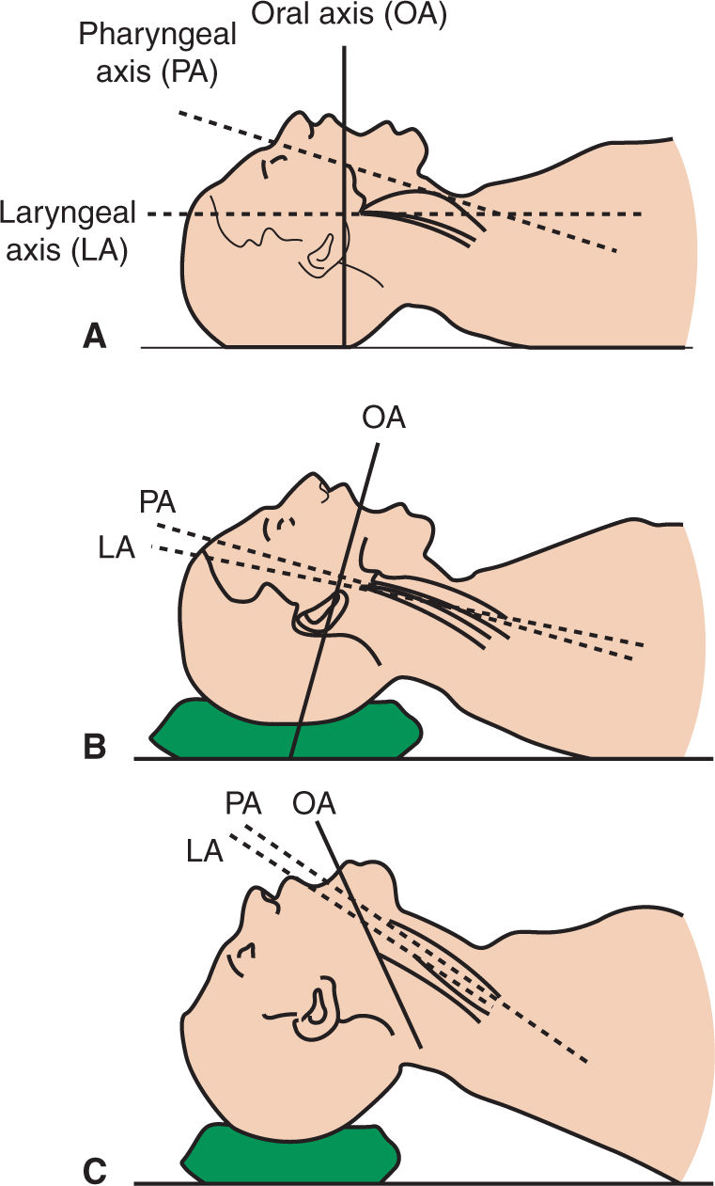 Airway Management Anesthesia Key