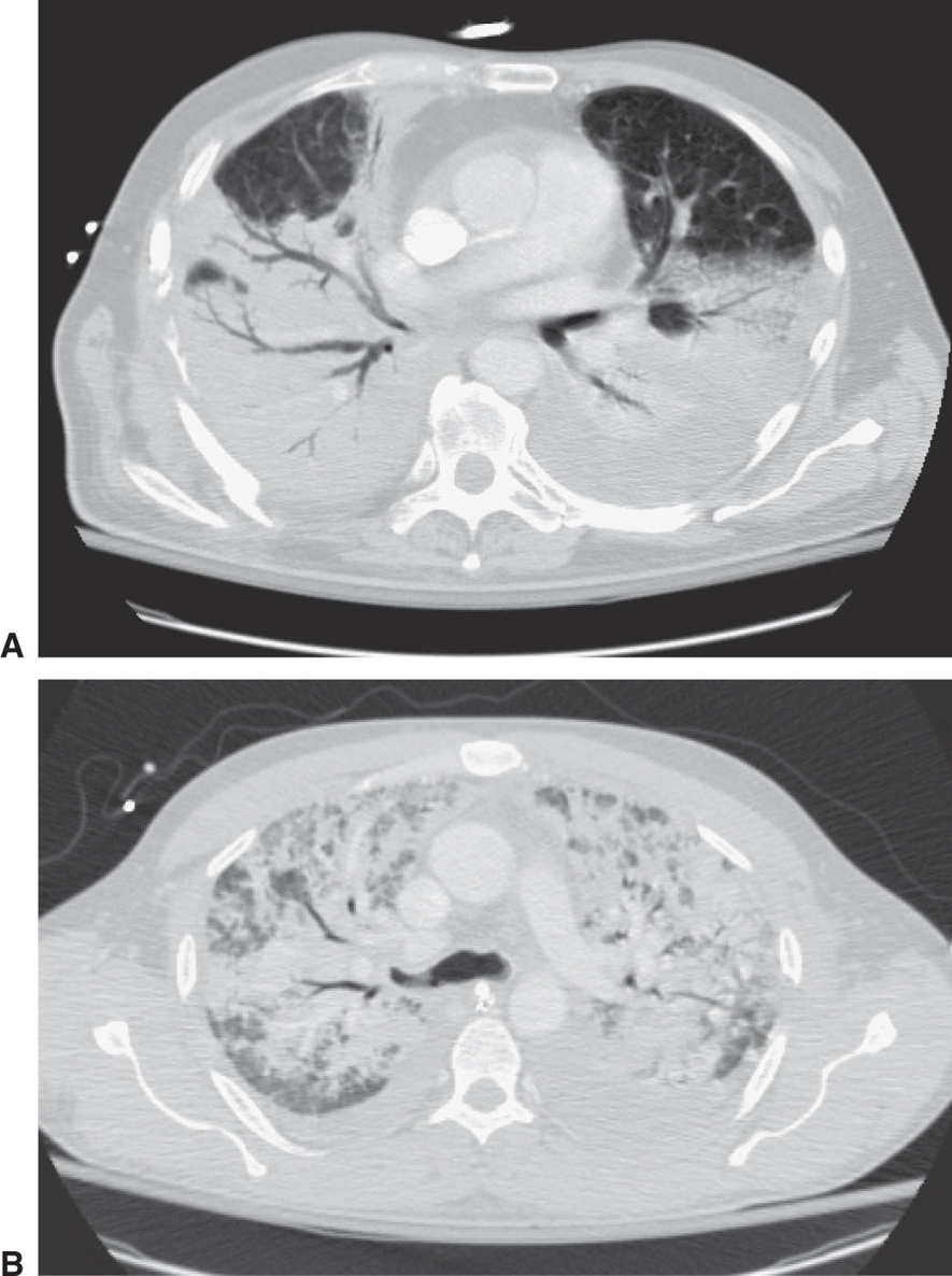 Icd 10 Dx Code For Aspiration Pneumonia