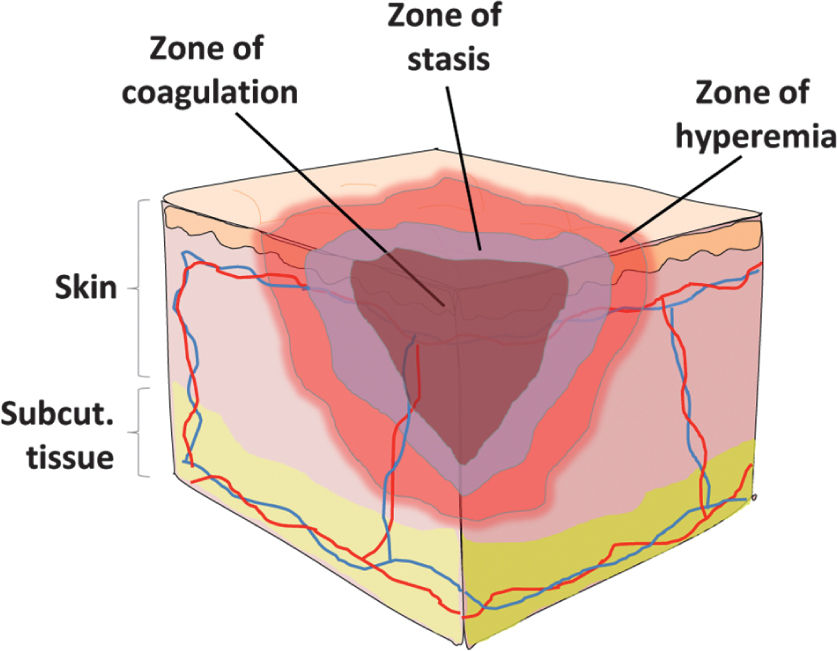 Burn Critical Care Anesthesia Key