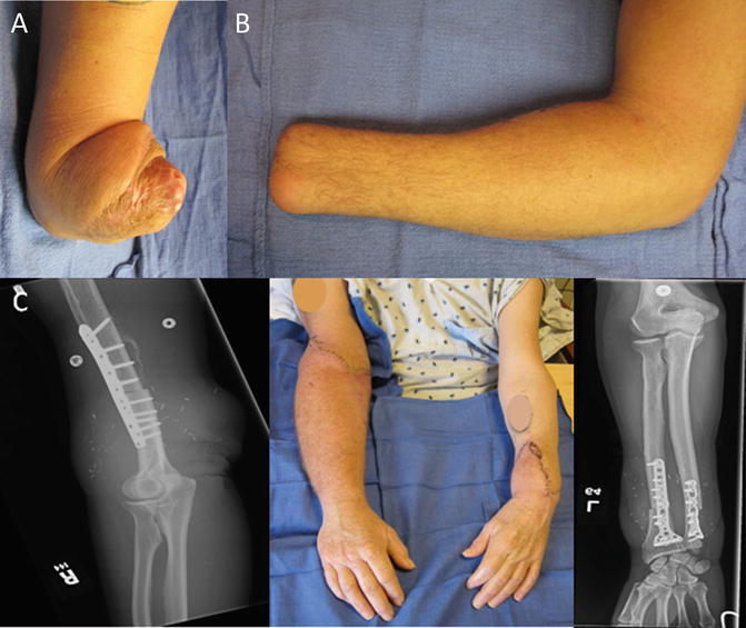 Limb Transplantation Anesthesia Key