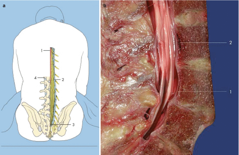 Neuraxial Blocks Spinal and Epidural Anesthesia Anesthesia Key