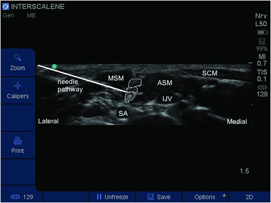 Ultrasoundguided interscalene brachial plexus block Anesthesia Key