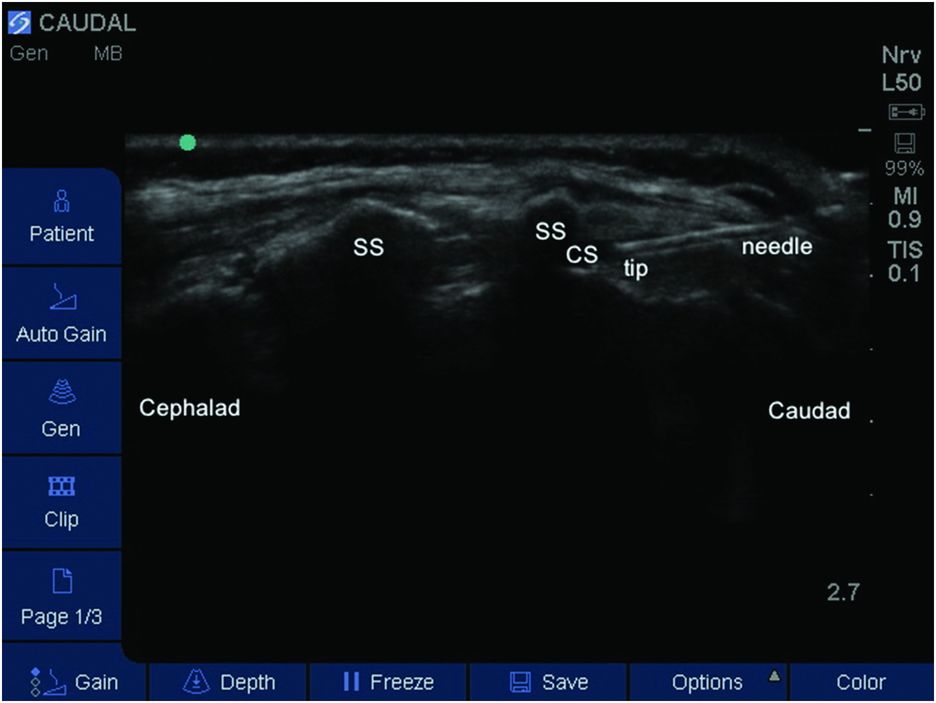 Ultrasoundguided caudal block Anesthesia Key