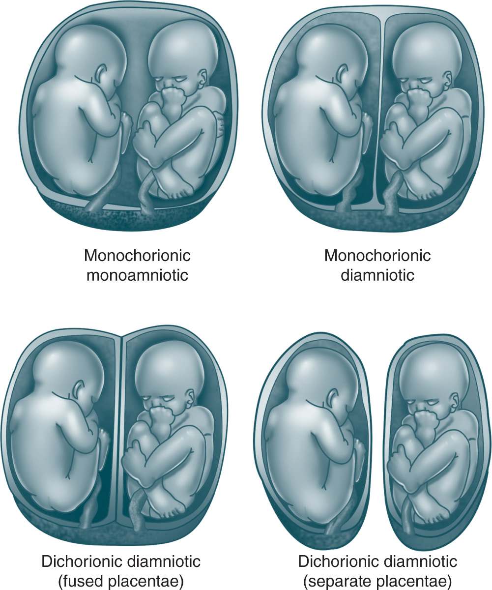 Identical Twins Placenta