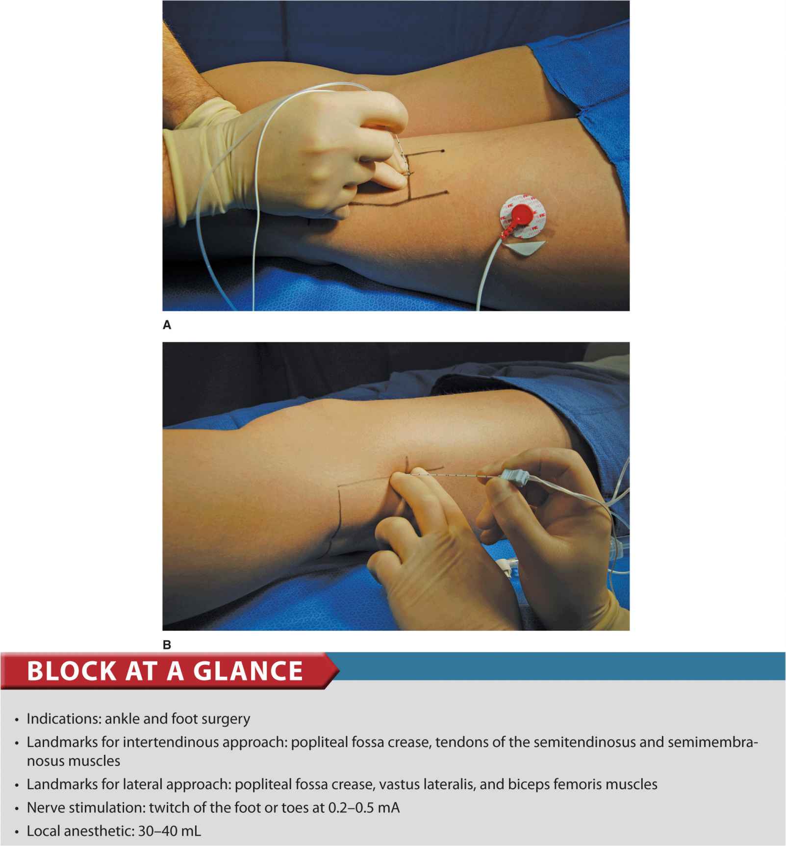 Popliteal Sciatic Block Anesthesia Key
