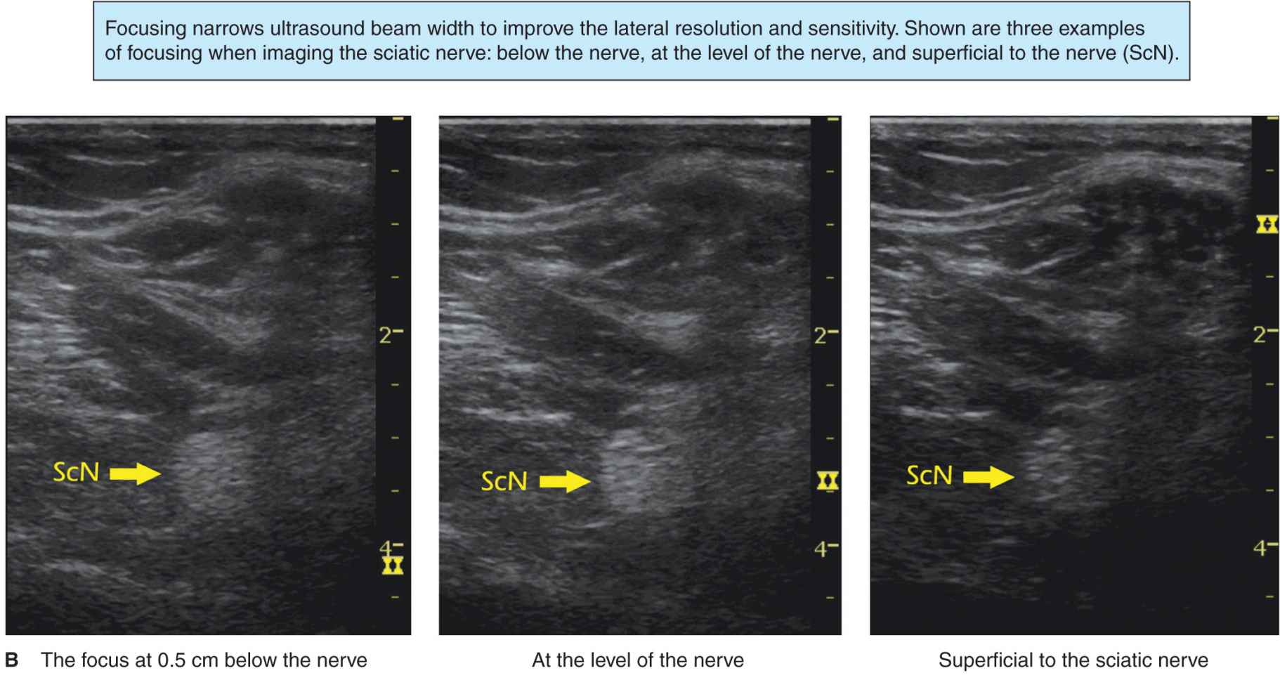 Optimizing an Ultrasound Image Anesthesia Key