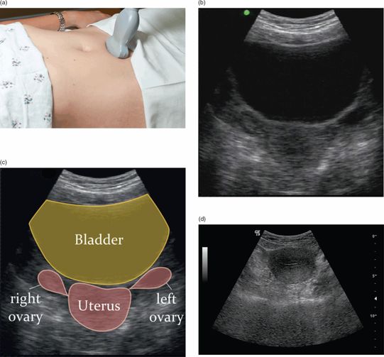 Pelvic obstetrics Anesthesia Key