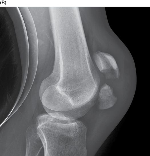 Fractures and dislocations of the knee and leg Anesthesia Key