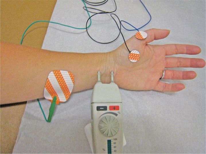 EMG and Nerve Conduction Studies Anesthesia Key