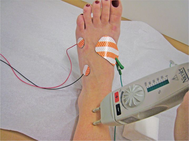 EMG and Nerve Conduction Studies Anesthesia Key
