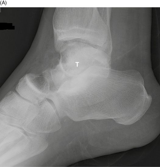 Fractures and dislocations of the tarsal bones Anesthesia Key