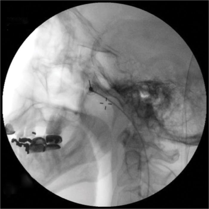 Sphenopalatine Ganglion Nerve Block