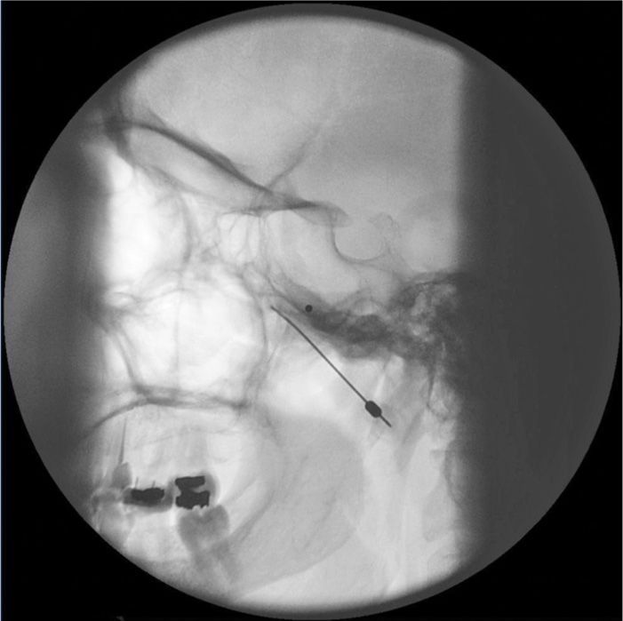 Sphenopalatine Ganglion Block Anesthesia Key
