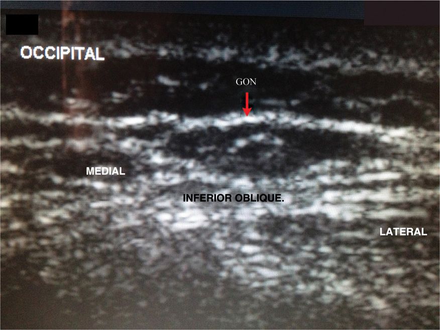 Occipital Nerve Blocks Anesthesia Key