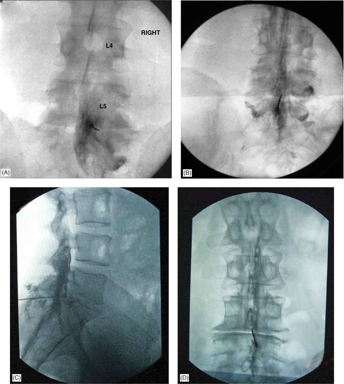 Interlaminar Epidural Steroid Injections Cervical, Thoracic, Lumbar