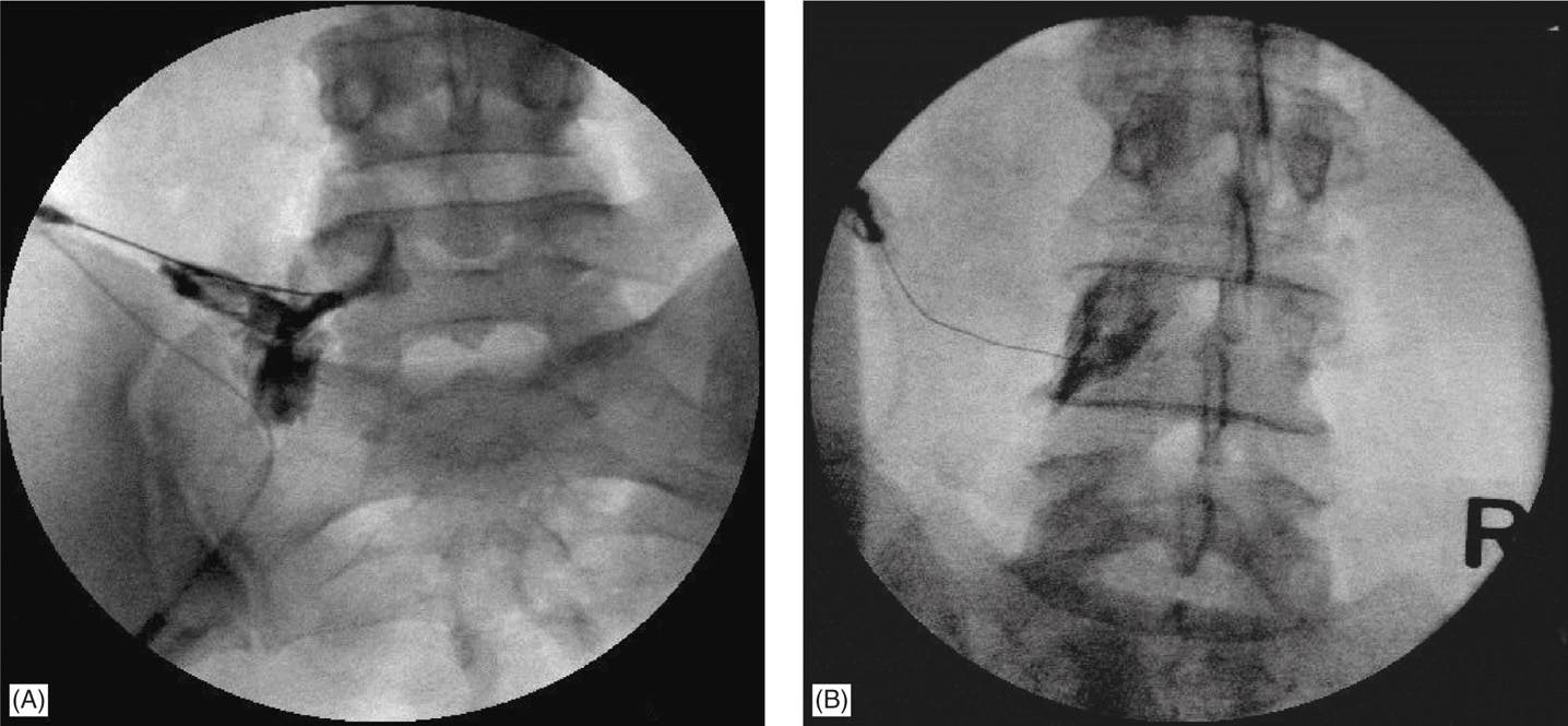 Transforaminal Epidural Steroid Injection Anesthesia Key