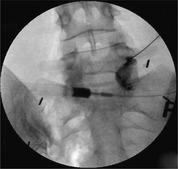Epidural Steroid Injection L5 S1
