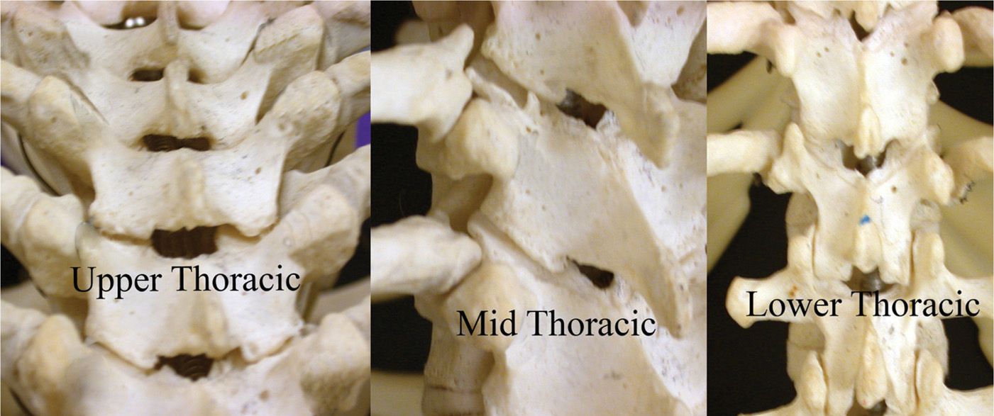 Facet Joint Interventions IntraArticular Injections, Medial Branch