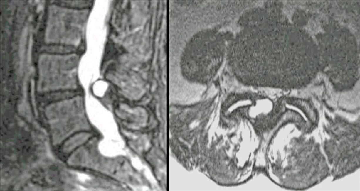 Lumbar Facet Joint Cyst Drainage and Injection Anesthesia Key