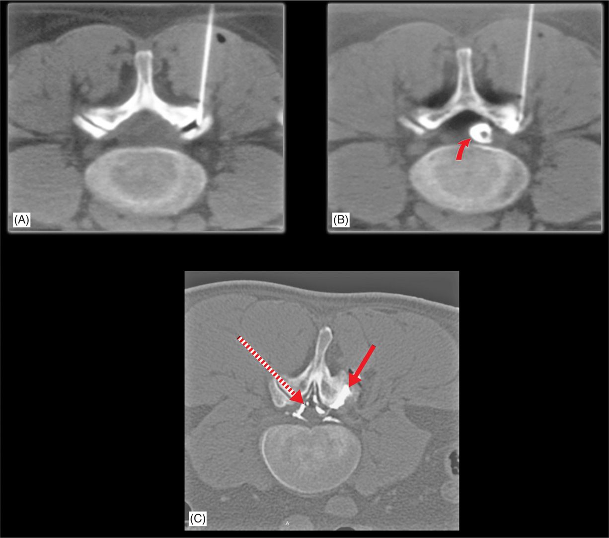 Facet Joint Effusion Definition at Helen Stapleton blog