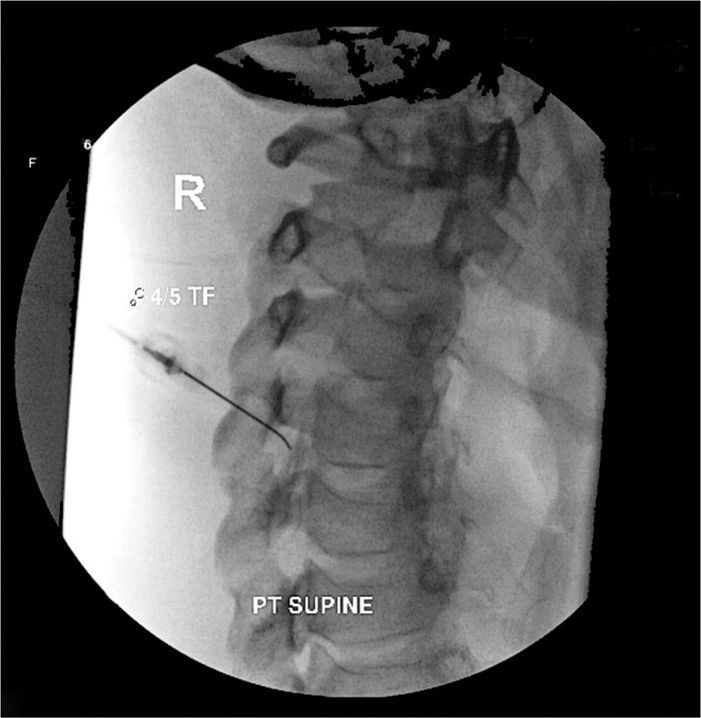 Dorsal Root Ganglion Blocks and Radiofrequency Procedures Anesthesia Key