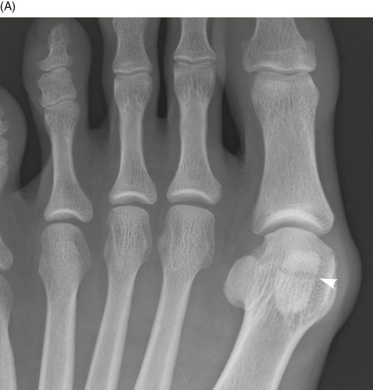 Fractures and dislocations of the metatarsals and toes Anesthesia Key