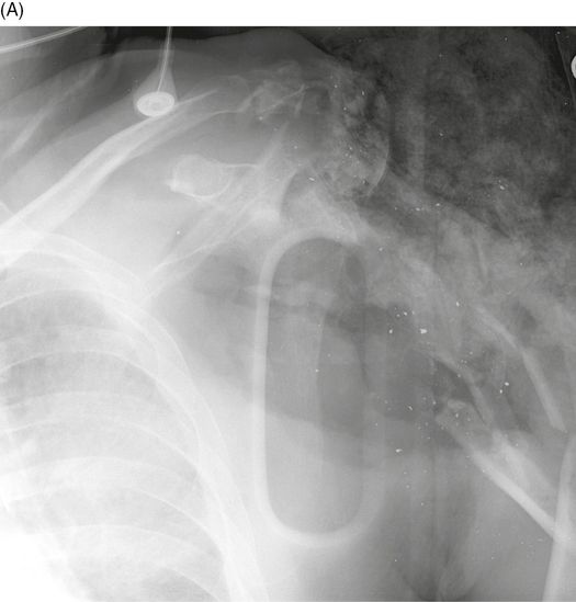 Fractures and dislocations caused by bullets and blasts (nonmilitary