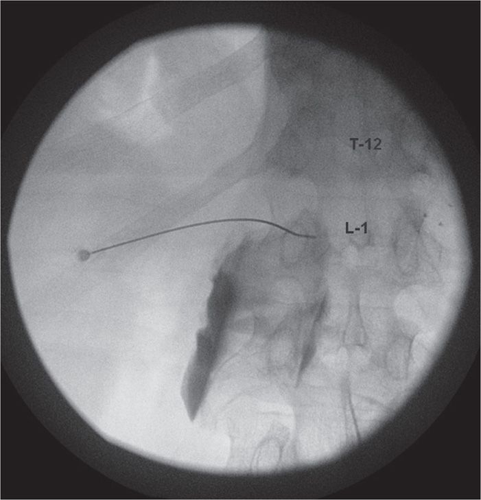 Celiac Plexus Block Using Fluoroscopic Guidance Anesthesia Key