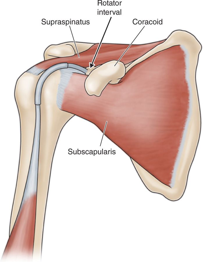 IntraArticular Joint Injections Anesthesia Key