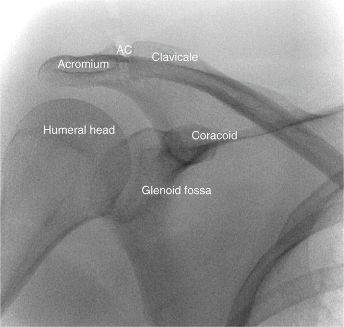 IntraArticular Joint Injections Anesthesia Key