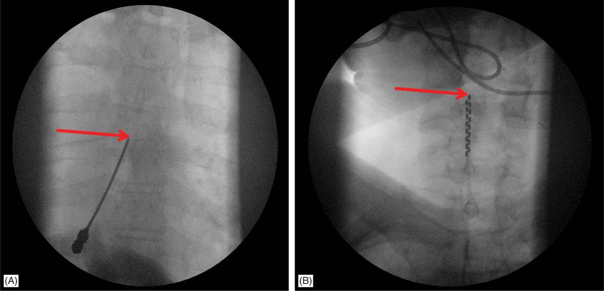 Spinal Cord Stimulation Implantation Techniques Anesthesia Key